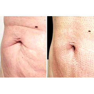 Tratament corporal plasma pen