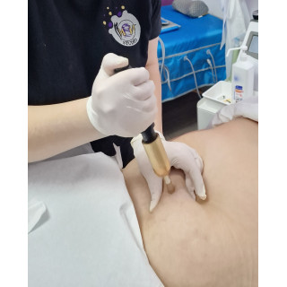 Lipoliză corporală