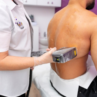 Epilare definitivă bărbați  -  pectorali+abdomen+axile+spate total