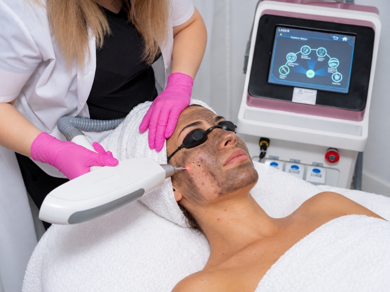 Laser Carbon Peel pentru acnee și sebum Ploiești