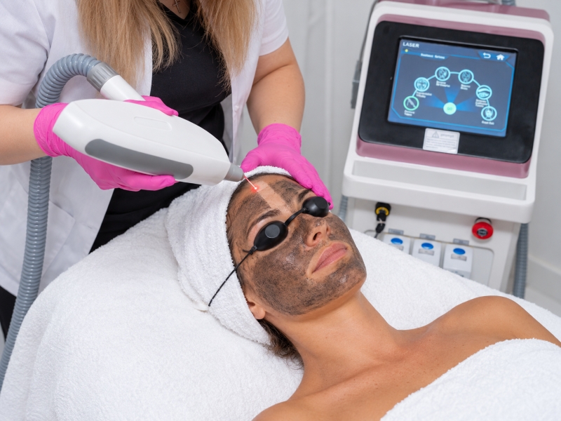Laser Carbon Peel facial Ploiești MBM Studio