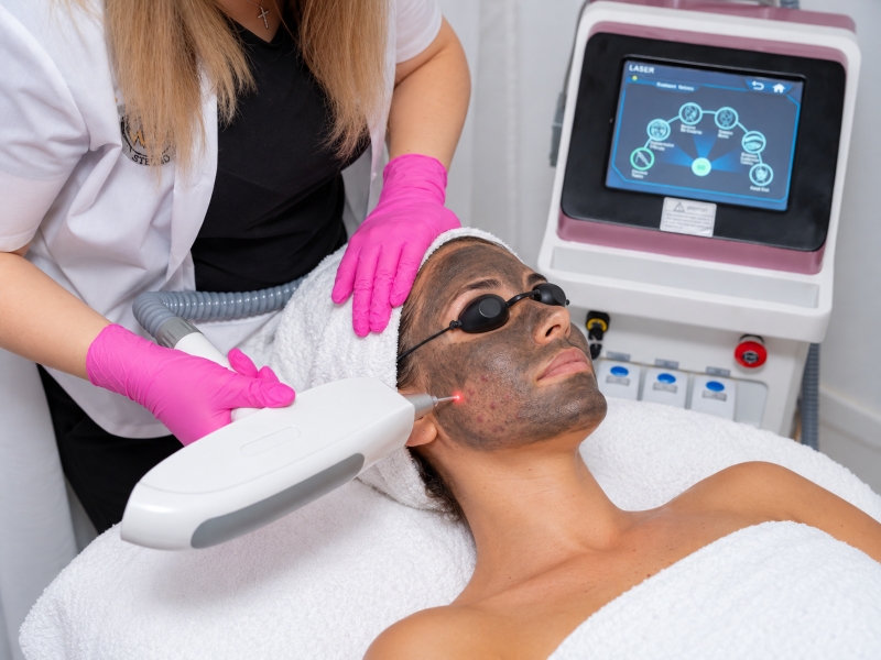 Laser Carbon Peel pentru pori și imperfecțiuni Ploiești