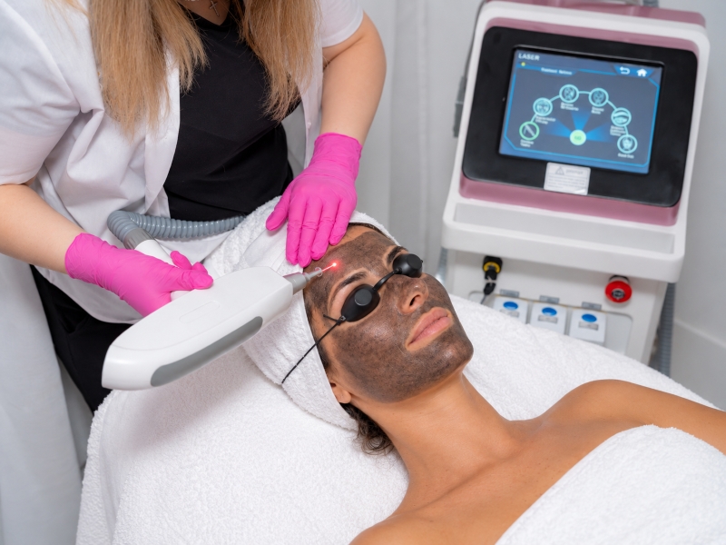 Aplicare Laser Carbon Peel pe frunte Ploiești MBM Studio