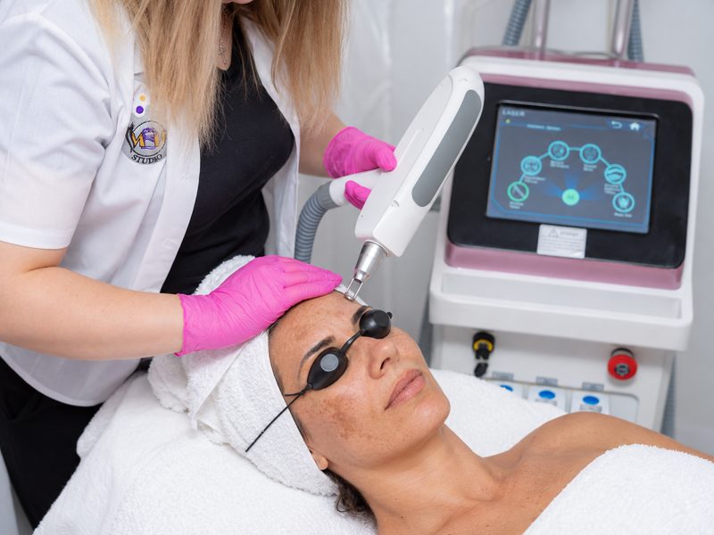 Tratament laser Nd:YAG pentru pete pigmentare punctuale la MBM STUDIO Ploiești