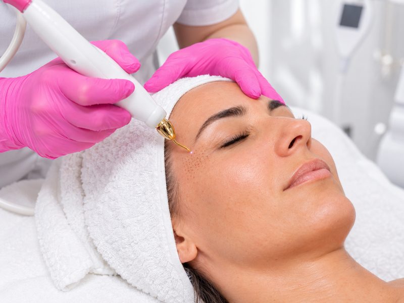 Plasma Pen facial cicatrici și imperfecțiuni Ploiești MBM Studio