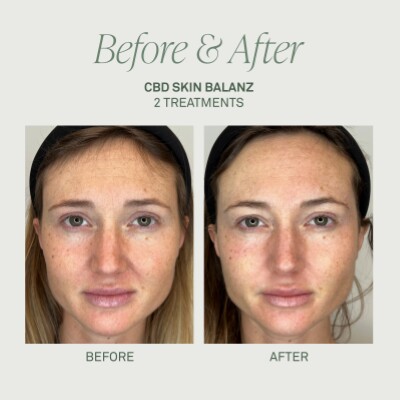 Comparație înainte și după două ședințe Infuzion System CBD Skin Balanz